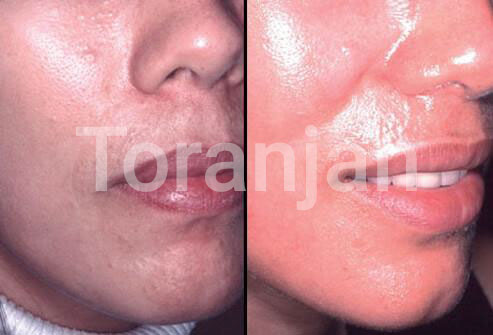 لایه‌برداری پوست با لیزر: قبل و بعد - ترنجان