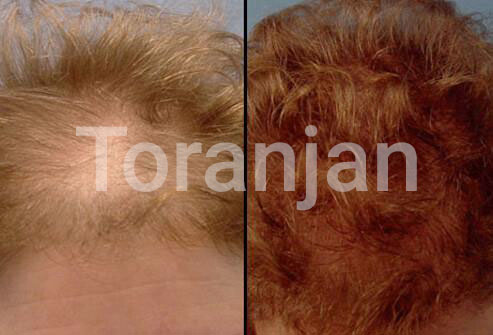 کاشت مو: قبل و بعد - ترنجان