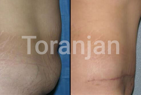 جراحی زیبایی شکم: قبل و بعد - ترنجان