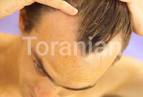 عامل 90% ریزش مو در مردان، ژنتیک است - ترنجان