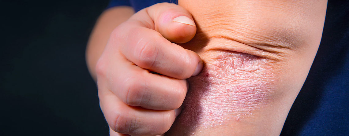 7 نکته برای مراقبت از پوست دچار پسوریازیس - ترنجان