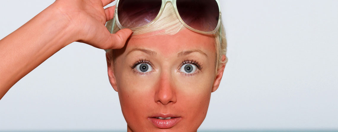 آفتاب‌سوختگی و واکنش‌های دیگر پوست نسبت به نور خورشید - ترنجان