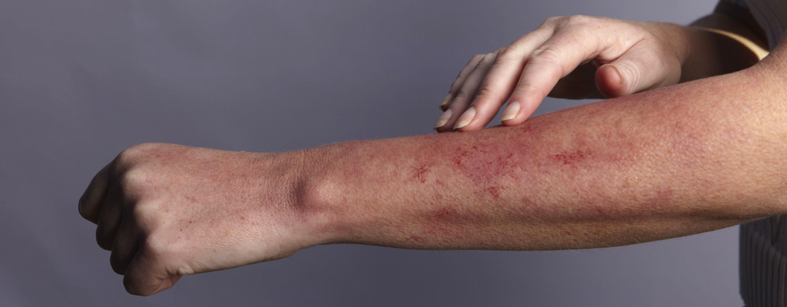 اسلایدهایی درباره عوارض پوستی شایع در بین بزرگ‌سالان - ترنجان