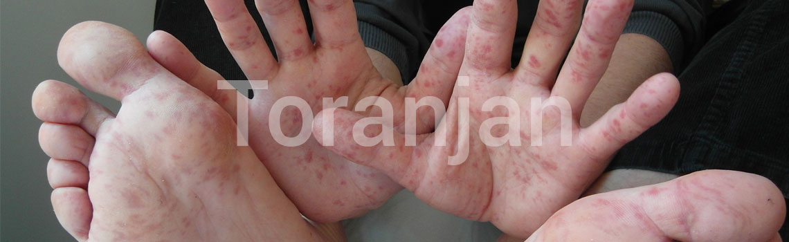 بیماری‌های پوستی که ظاهر بسیار بدی دارند - بیماری دست، پا و دهان - ترنجان