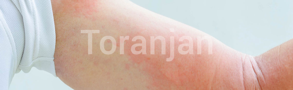 بیماری‌های پوستی که ظاهر بسیار بدی دارند - کهیر یا اورتیکاریا - ترنجان