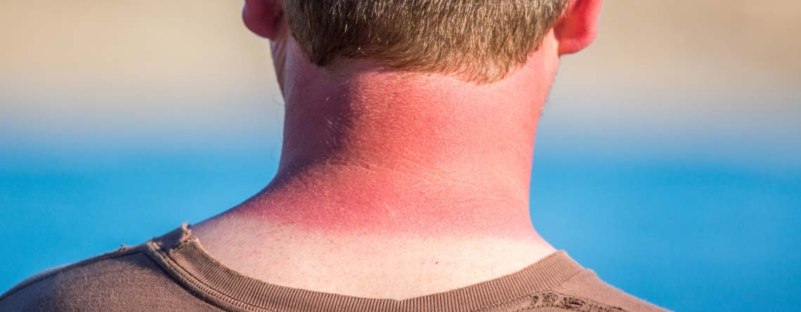 آسیب‌دیدگی پوست در اثر نور خورشید - روش‌های تشخیص پوست آسیب‌دیده - ترنجان