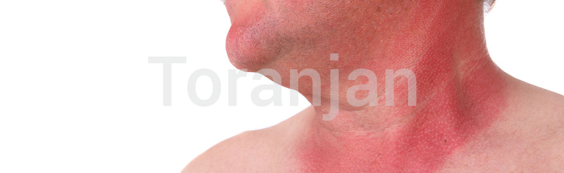 عوارض پوستی شایع در فصل تابستان - آفتاب‌سوختگی‌ها - ترنجان