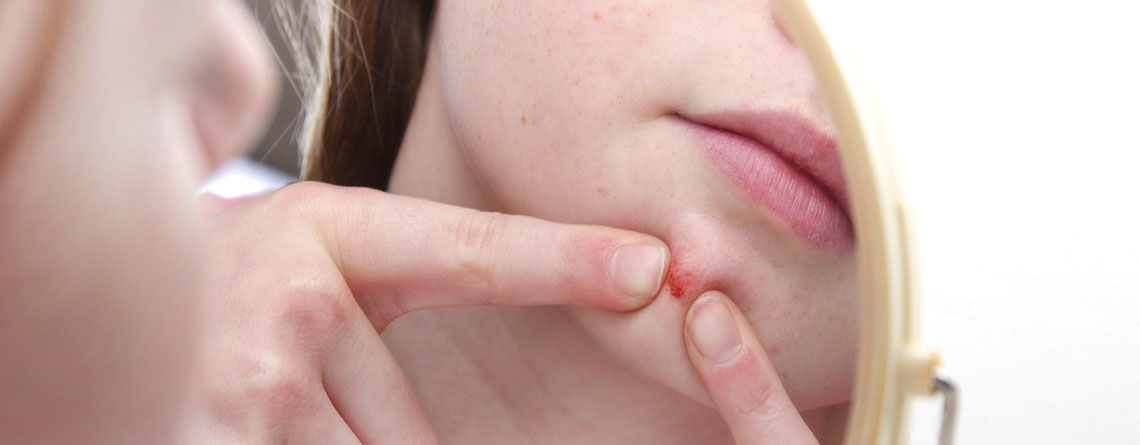 آکنه هورمونی: درمان‌های سنتی، درمان‌های طبیعی و بسیاری درمان‌های دیگر - بخش دوم - ترنجان