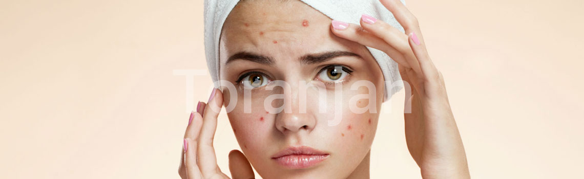 mujer-con-toalla-en-el-cabello-y-con-acne-en-el-rostro