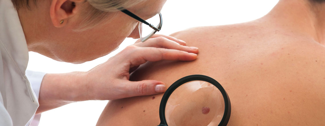 5 نشانه سرطان‌ پوست و 4 درمان طبیعی و میزان تاثیرات این درمان‌ها - بخش چهارم - ترنجان